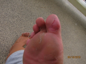 Ugly Feet!
